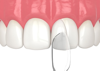 Dental BondingDental bonding can repair a variety of tooth flaws in one treatment 