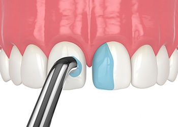 Dental bonding can repair minor chips and discoloration of the teeth