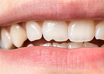 patients with minor chips on their teeth are often good candidates for dental bonding