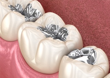 Illustration of teeth with amalgam fillings